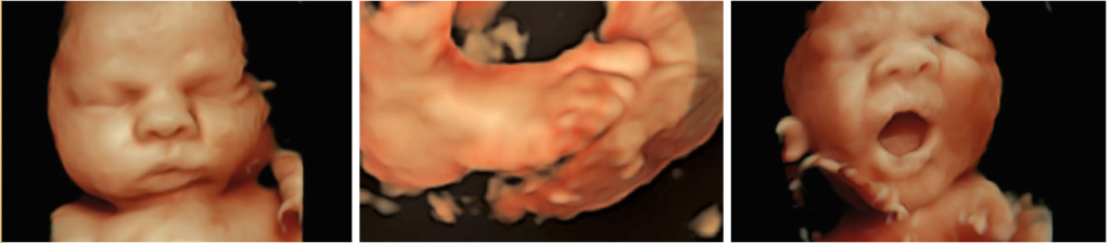 3D Ultrasound images