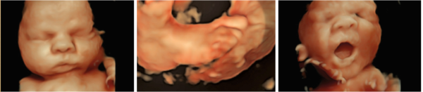 3d & 4d Ultrasound – San Diego Perinatal Center